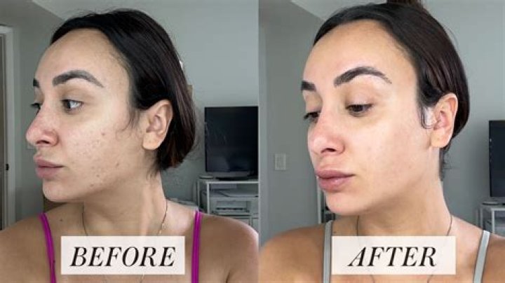 Should you moisturizer before retinol?