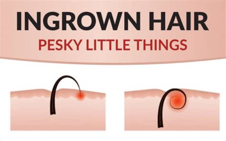 Should you pop an ingrown hair?