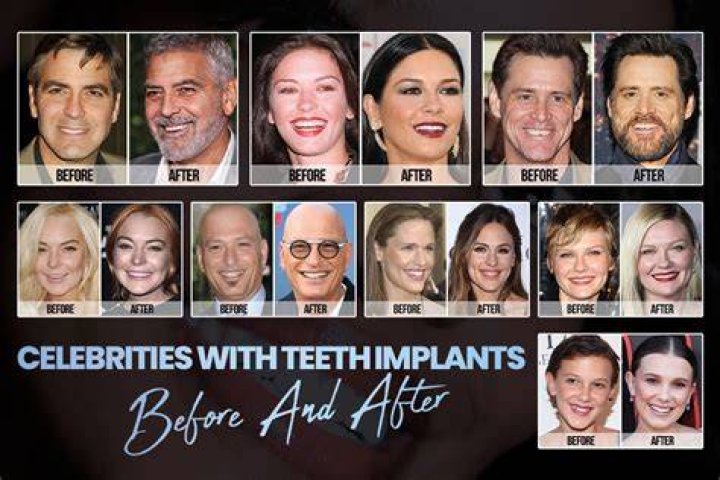 What actress has dental implants?