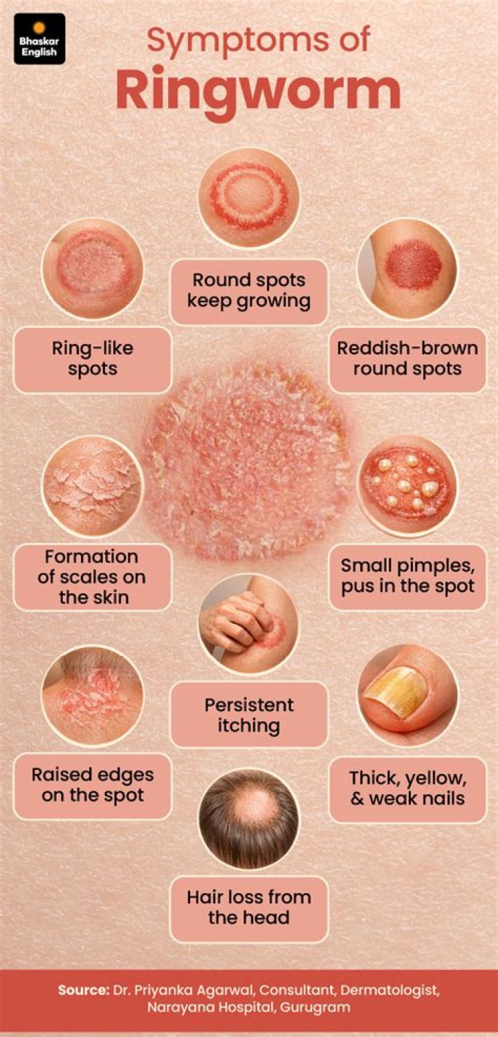 What are 3 symptoms of ringworm?