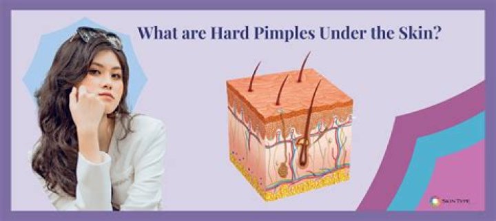 What are hard pimples?