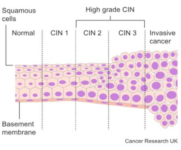 What are high-grade precancerous cells in cervix?