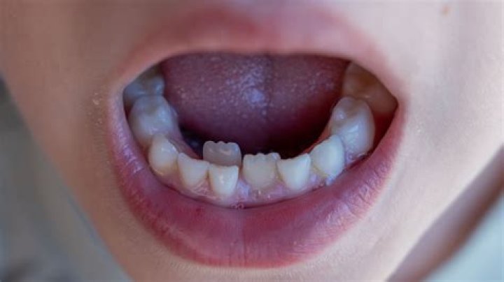 What are popcorn teeth?