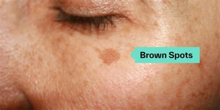 What are the brown spots on my arm?