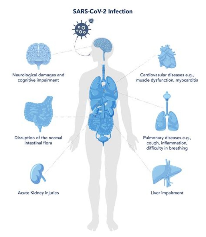 What are the complications of COVID-19?