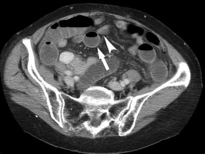 What are the warning signs of a bowel obstruction?