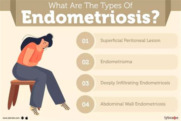 What are three signs of endometriosis?