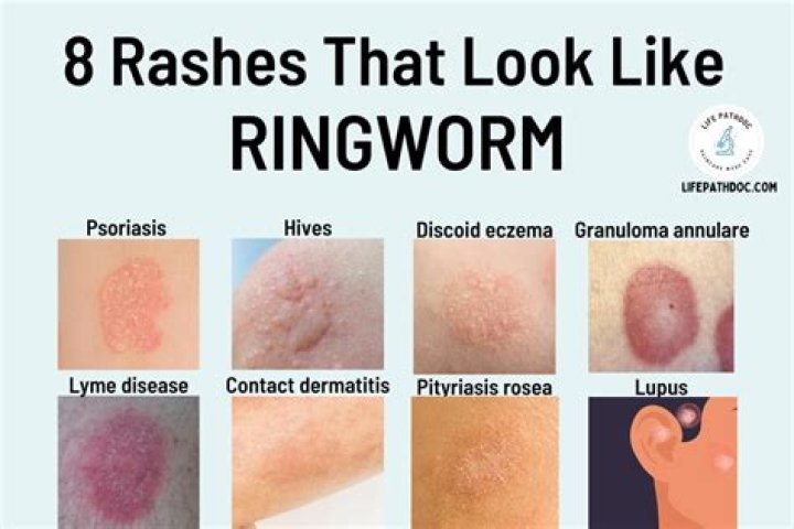 What can be mistaken for ringworm?