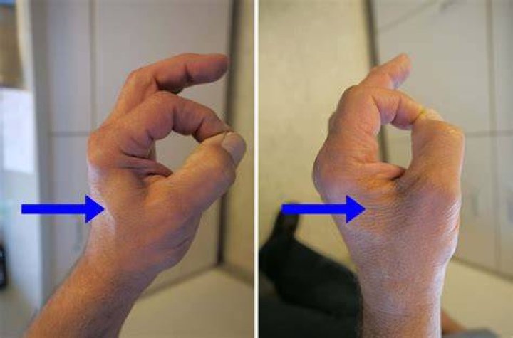 What can cause nerve damage in wrist?