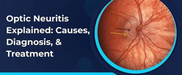 What can cause optic neuritis Besides MS?
