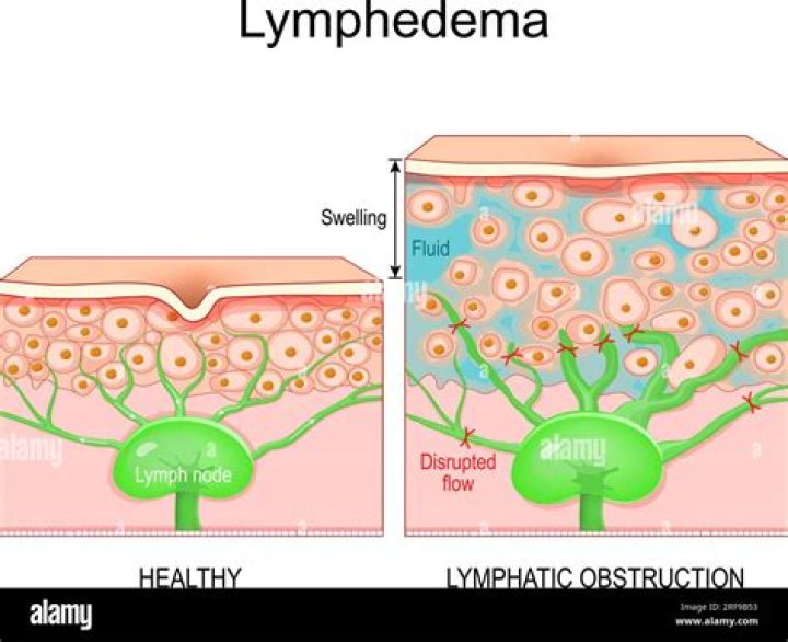 What causes lymphatic fluid build up?