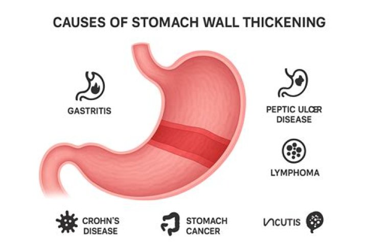 What causes thickening of the stomach?