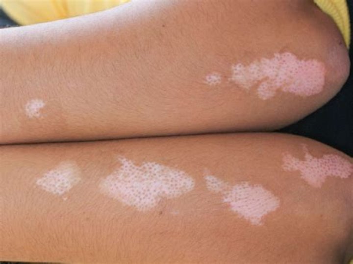 What causes white patches on the skin?