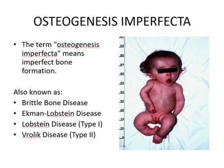 What chromosome is amelogenesis imperfecta on?