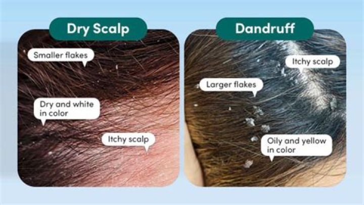 What color is dandruff?