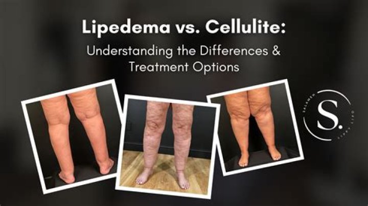 What cream gets rid of cellulite?