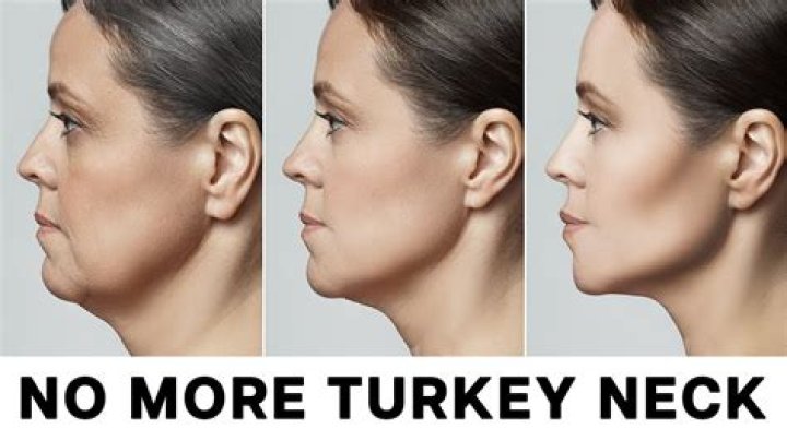 What cream is best for turkey neck?