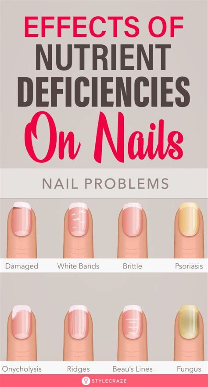What do nails with vitamin deficiency look like?