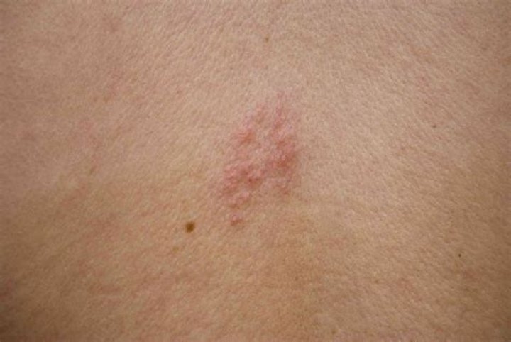 What do shingles spots look like?