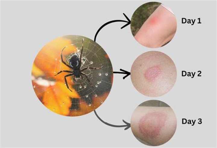 What do u do for spider bites?