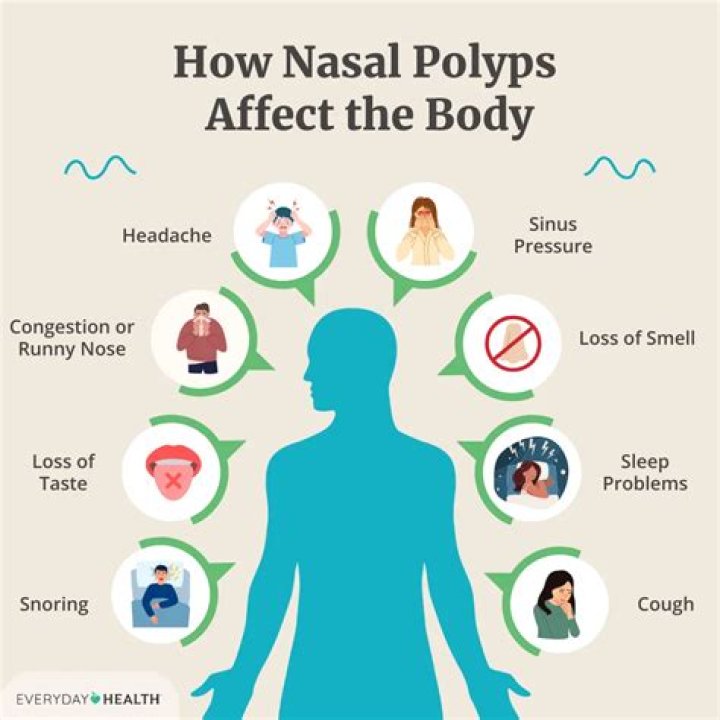 What does a nasal polyp look like when it comes out?