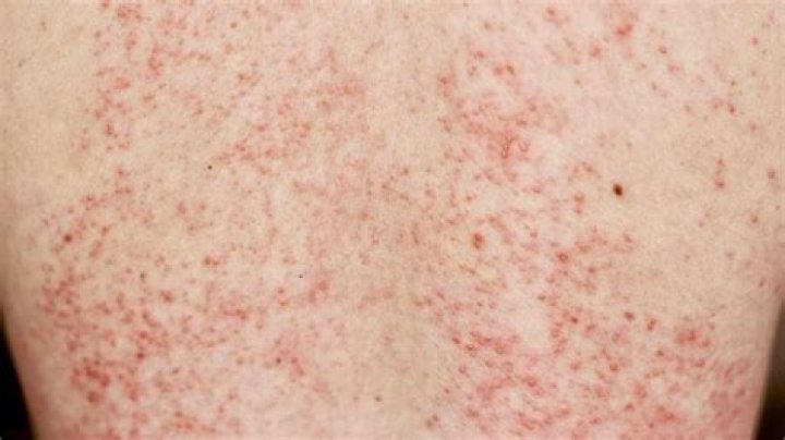 What does a sjogrens rash look like?