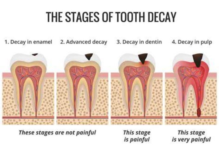 What does an untreated cavity look like?