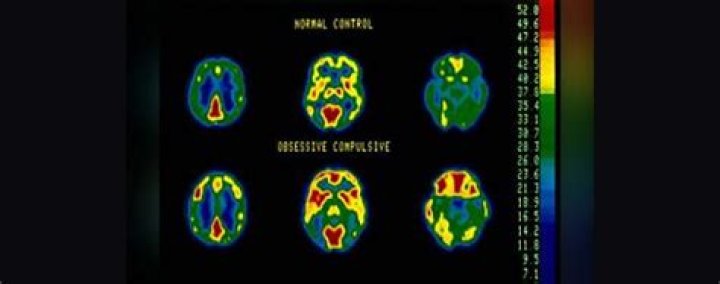 What does extreme OCD look like?