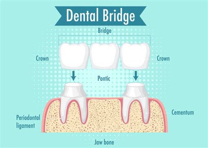 What does finesse mean in bridge?