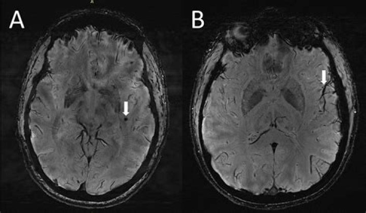 What does migraine look like on MRI?