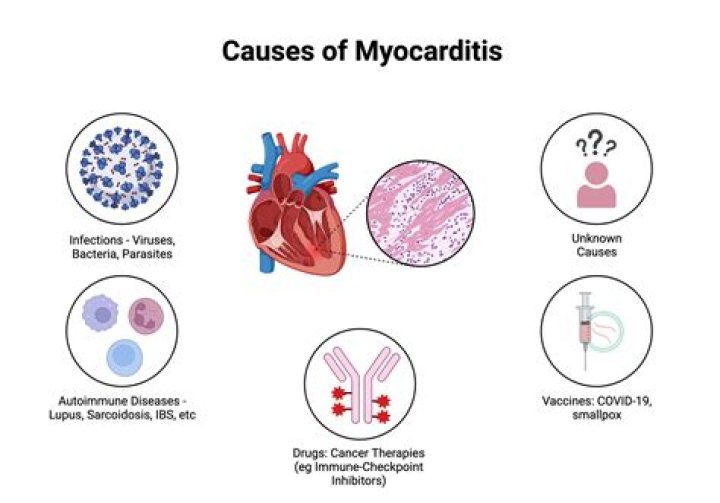 What does myocarditis pain feel like?