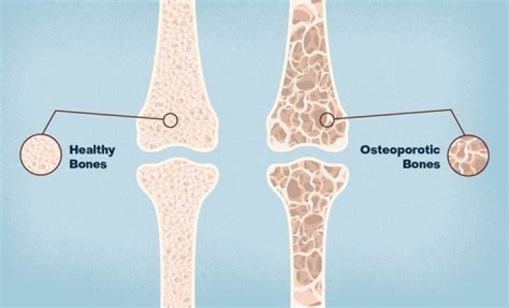 What does osteoporosis do to teeth?