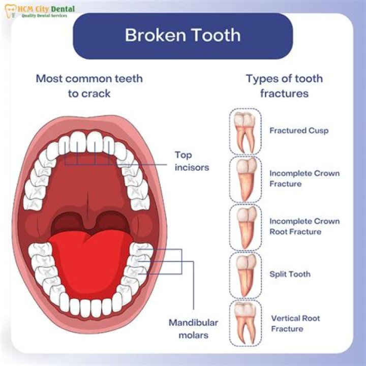 What does pain from a cracked tooth feel like?