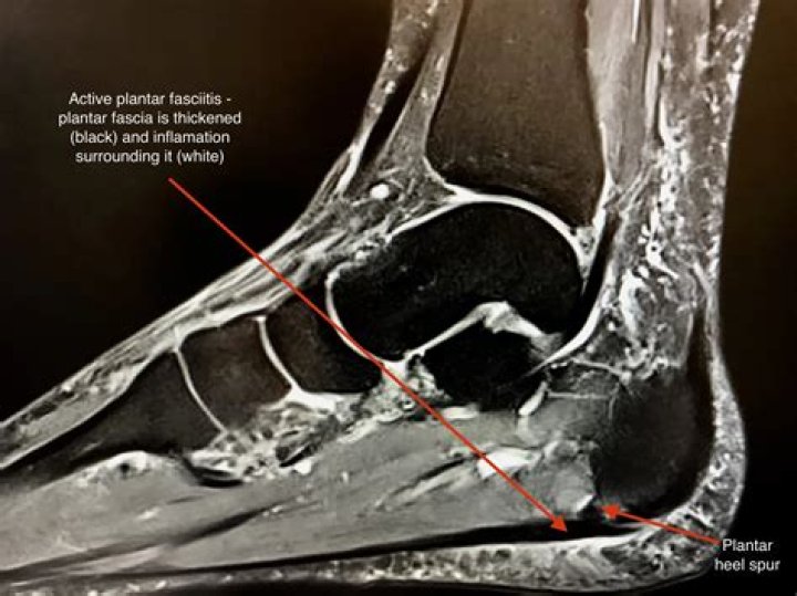 What does plantar fasciitis look like on an MRI?