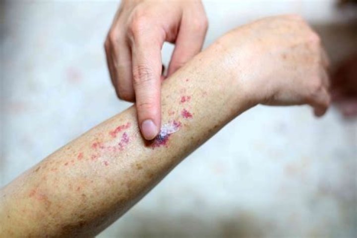 What does purpura spots look like?
