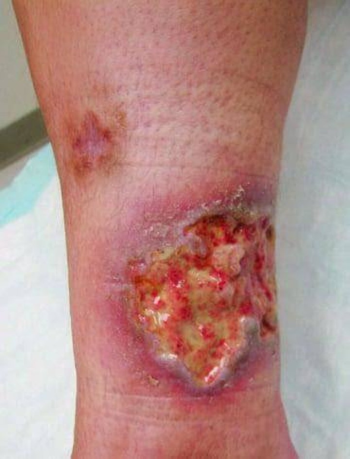 What does pyoderma Gangrenosum look like?