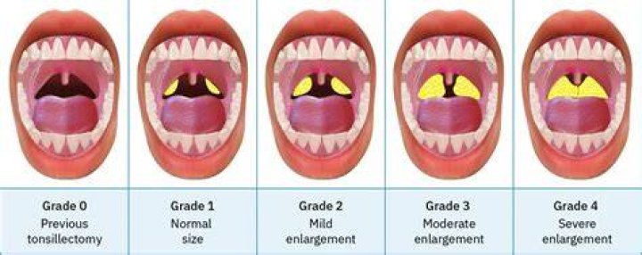 What does size 3 tonsils mean?