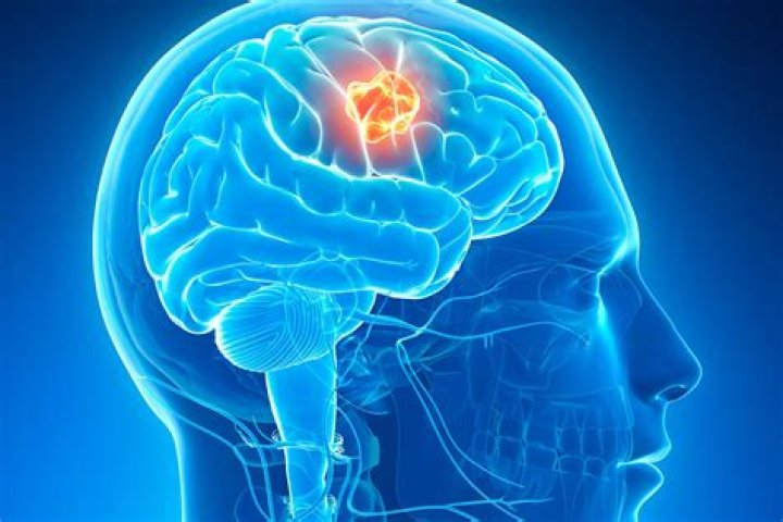 What food causes brain tumors?