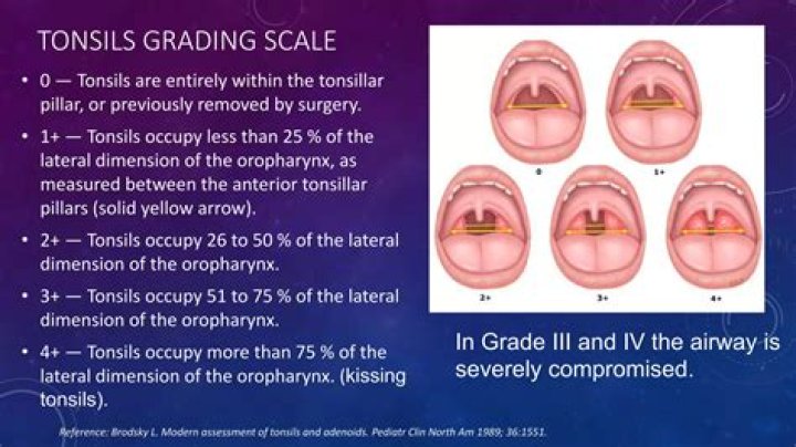 What grade are kissing tonsils?