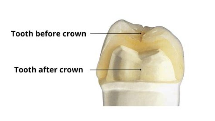 What happens if tooth cracks?