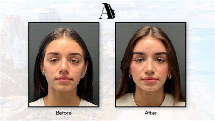 What happens if you cry after a nose job?