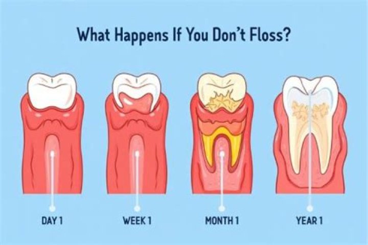 What happens if you don't floss?