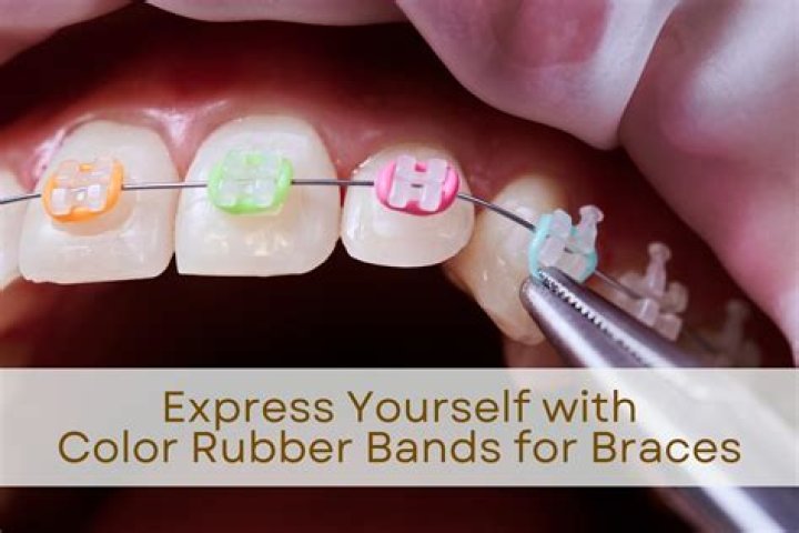 What happens if you double up on your rubber bands for braces?