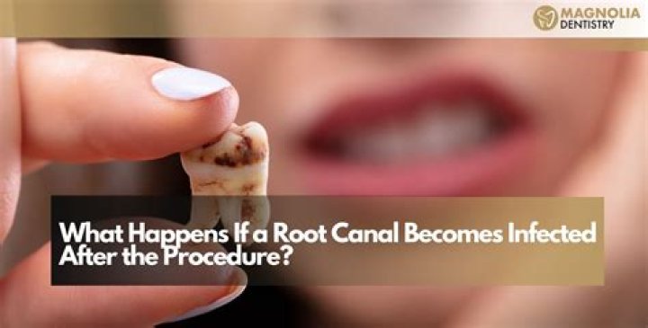 What happens if you leave an infected root canal untreated?