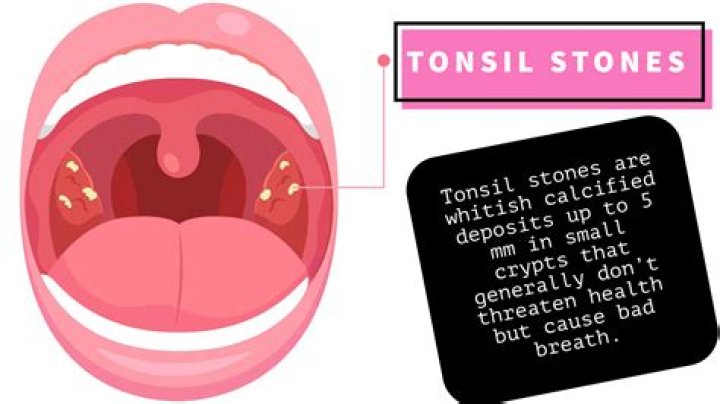 What happens if you pop your tonsil stones?