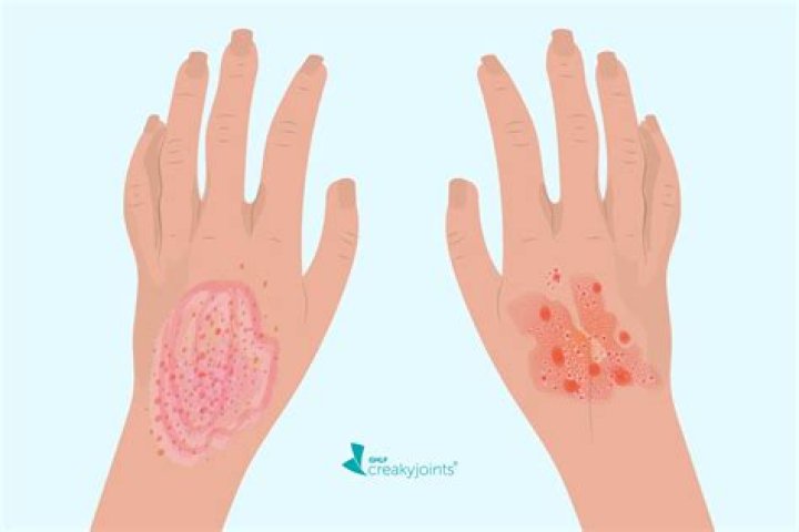 What inflames eczema?