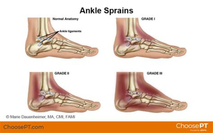 What is a Grade 3 ankle sprain?
