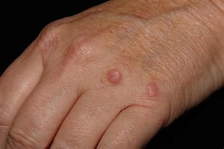 What is a granuloma on the skin?