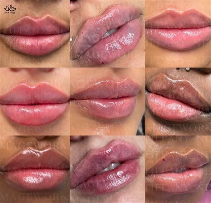 What is a Russian lip lift?