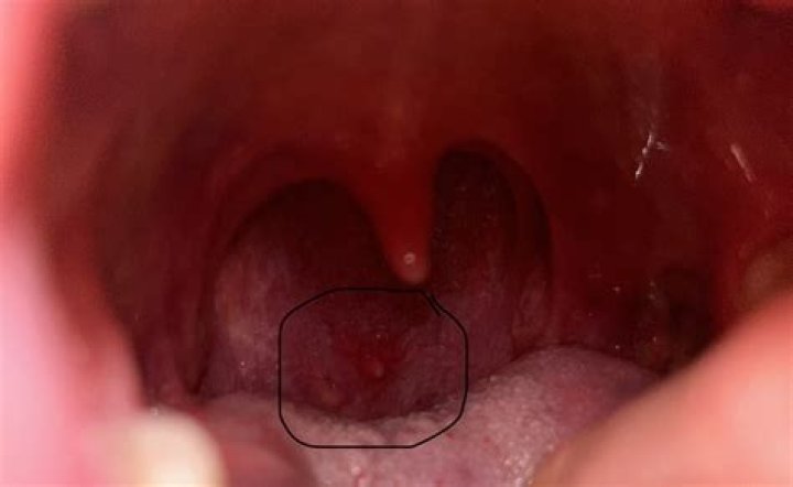 What is a throat nodule?